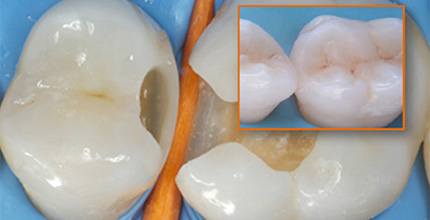Прямая художественная реставрация зубов в клинике Апекс-Д